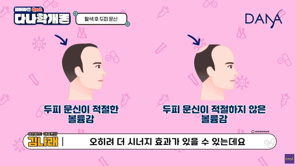 Scalp Micropigmentation: Is It Possible After Bleaching? image 5