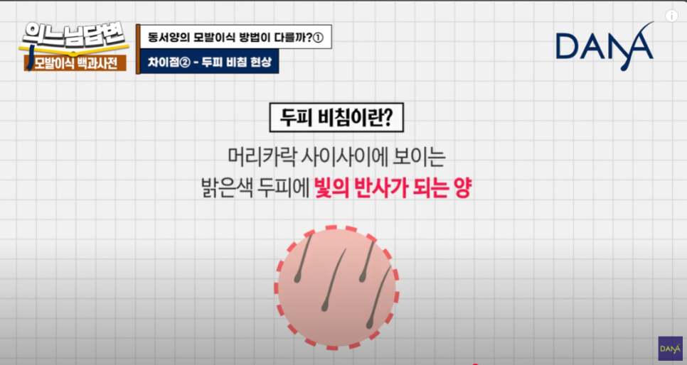 How Is Hair Transplantation Different by Race? image 9