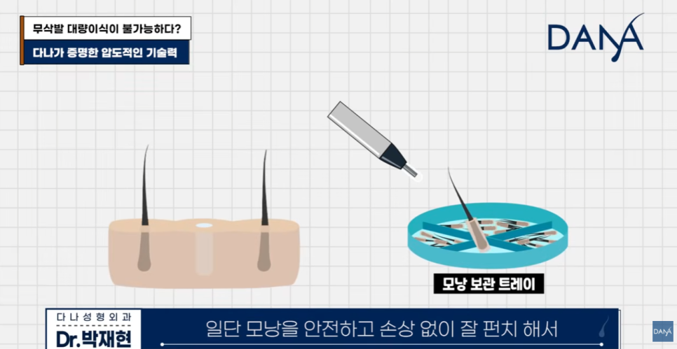무삭발 모발이식이르 3000모 대량이식 가능할까? 생착률 높이는 진짜비밀 관련 이미지 5