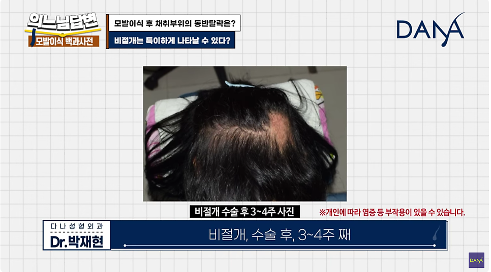 Hair Transplant Donor-Site Shedding That Can Occur After Hair Transplant Surgery image 5