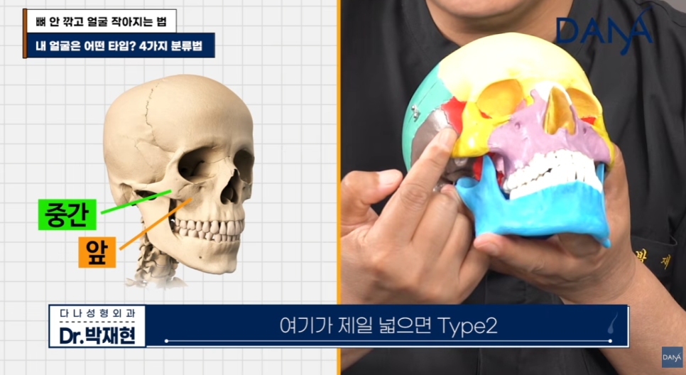 뼈 안 깎고 얼굴 작아지는 법? 광대 수술 효과 없는 관련 이미지 5