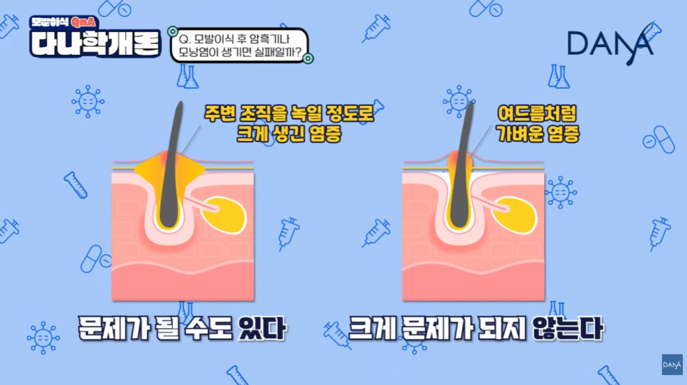 모발이식 후 모낭염, 수술 실패일까? 원인과 대처 꿀팁! 관련 이미지 20