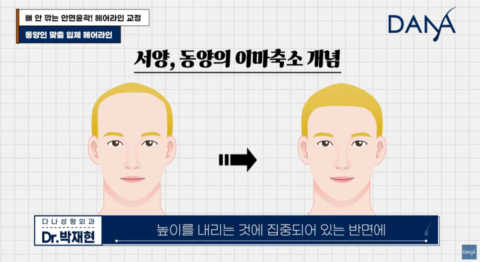 동양인vs서양인 이마 차이, 한국인에게 헤어라인 교정이 필수인 이유 관련 이미지 3