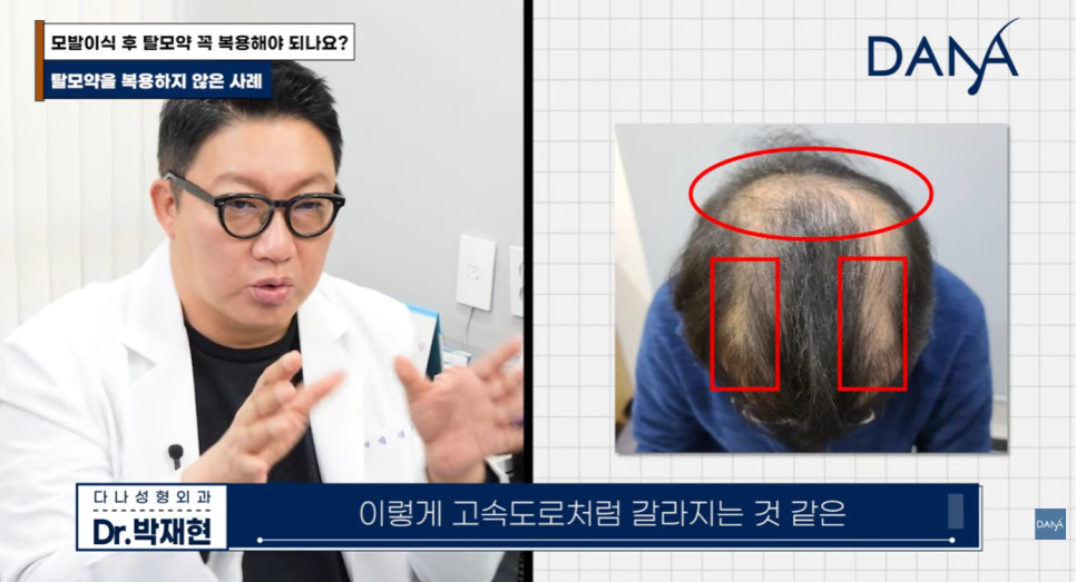 Is Taking Hair Loss Medication Essential After Hair Transplant? What Happens If You Don’t Take Propecia or Avodart image 10