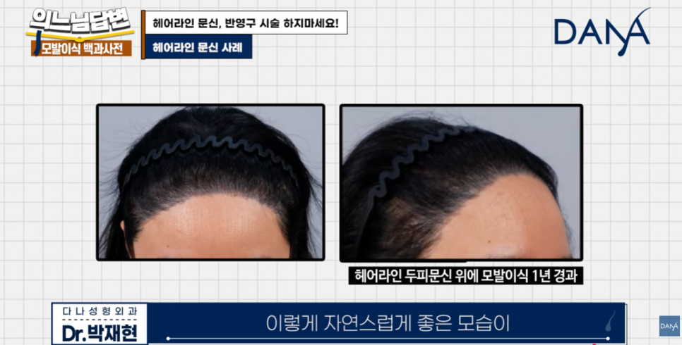 Why You Should Never Get a Hairline Scalp Tattoo image 12