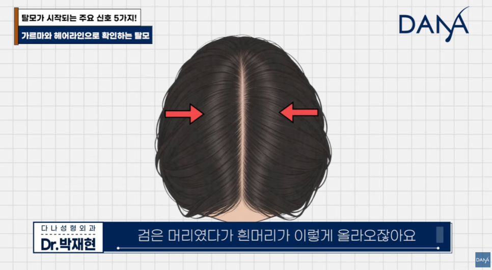 혹시 나도 탈모일까? 초기 증상 5가지와 10초 자가진단법 관련 이미지 16
