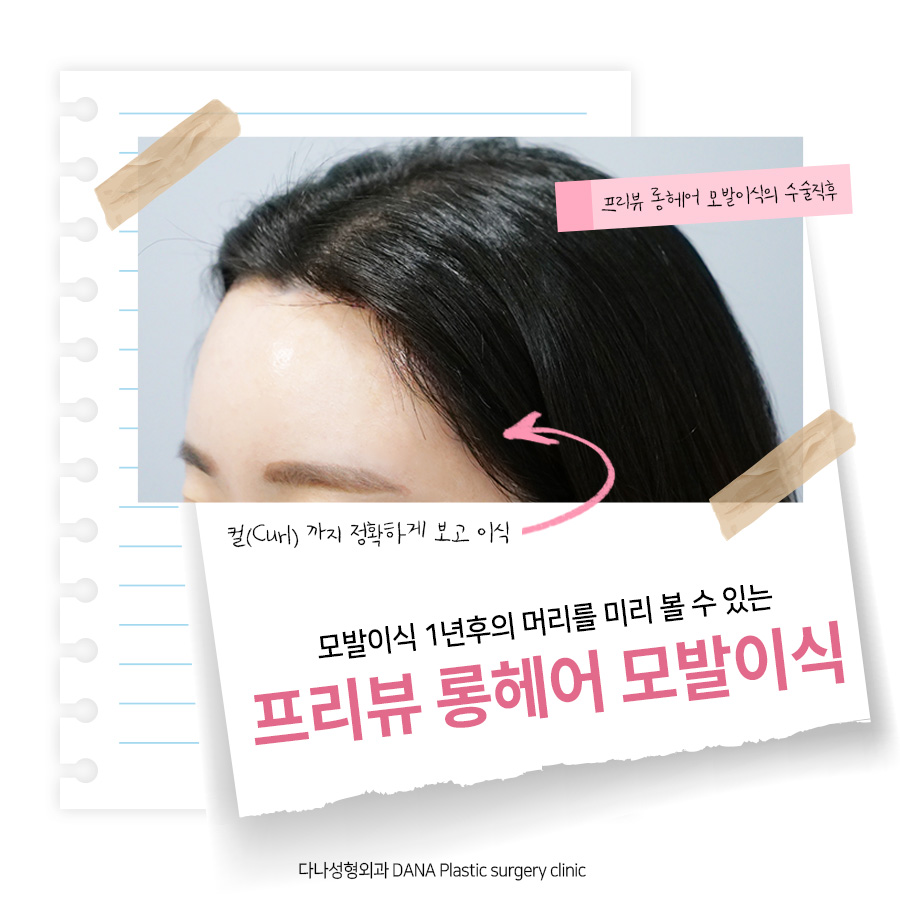 Preview Long Hair No-Shave Hair Transplant: No Visible Signs After Surgery and Back to Work the Next Day? image 1