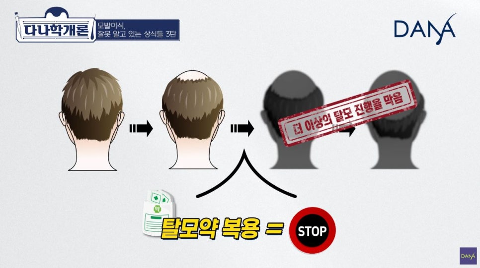 모발이식에 관해 잘못 알려진 상식들_3편 관련 이미지 15