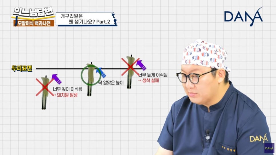 모발이식 개구리알 생기는 이유_2편 관련 이미지 4