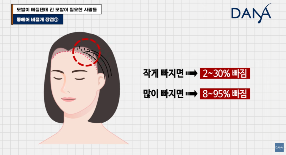 The Secret Behind Long-Hair, Non-Incisional Hair Transplants Chosen by Celebrities and CEOs—Staying Undetectable Even During the Shedding Phase image 6