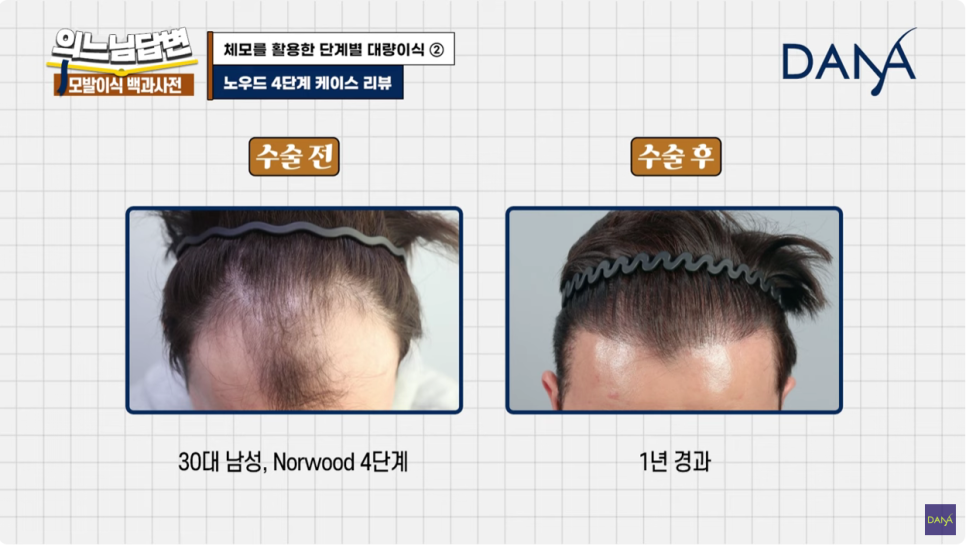 체모이식 체모를 활용한 단계별 대량이식 관련 이미지 18