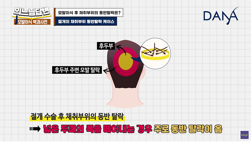 Hair Transplant Donor-Site Shedding That Can Occur After Hair Transplant Surgery image 6