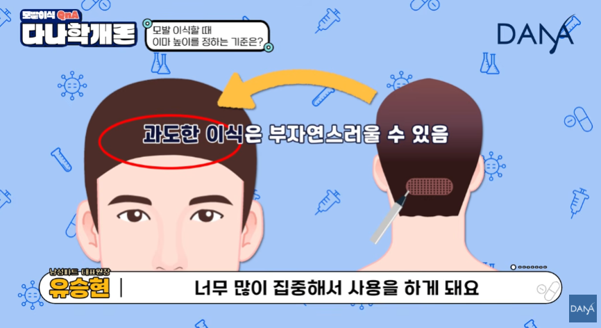 모발이식 이마 높이 정하는 기준! 무작정 낮추면 안되는 이유 관련 이미지 3
