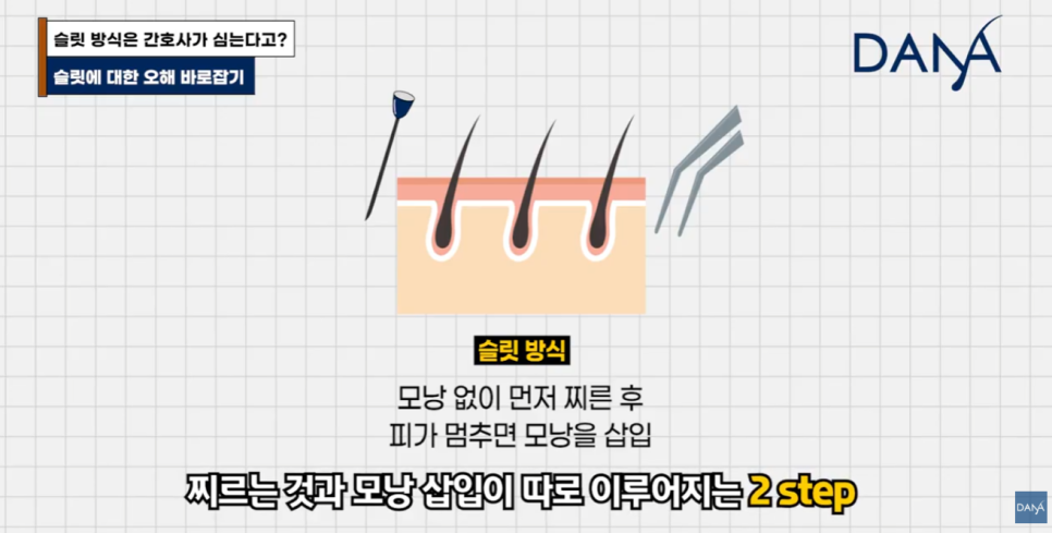 슬릿 방식은 간호사가 심는다? 모발이식 슬릿 vs 식모기 차이점 완벽 정리 관련 이미지 6