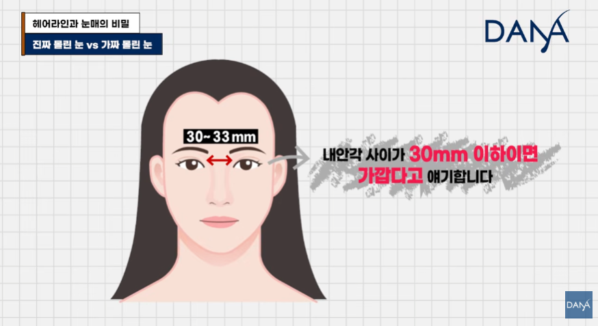진짜 몰린 눈 VS 가짜 몰린 눈! 눈매가 답답해 보이는 진짜 이유 관련 이미지 9