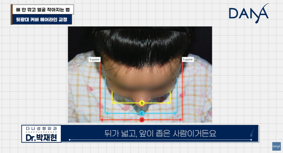 뼈 안 깎고 얼굴 작아지는 법? 광대 수술 효과 없는 관련 이미지 18