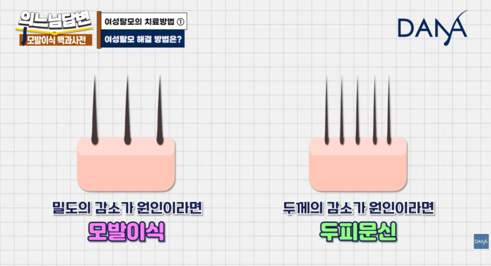 여성형 탈모, 두피문신vs모발이식? 관련 이미지 11