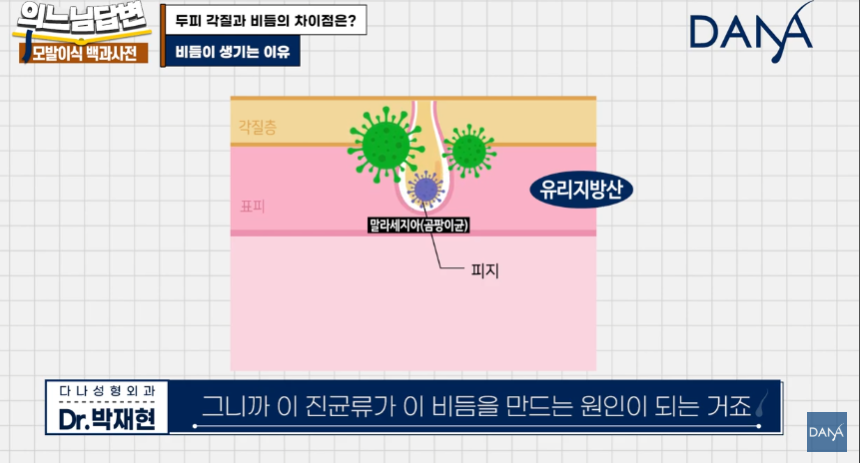 머리 잘 감아도 비듬 생기는 뜻밖의 원인! 두피 각질 차이 및 해결법 관련 이미지 8