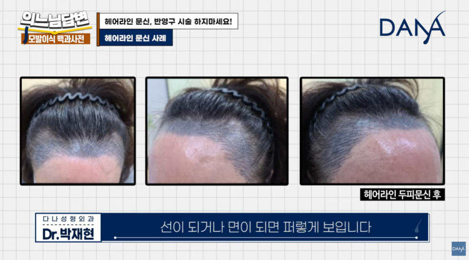 Why You Should Never Get a Hairline Scalp Tattoo image 9