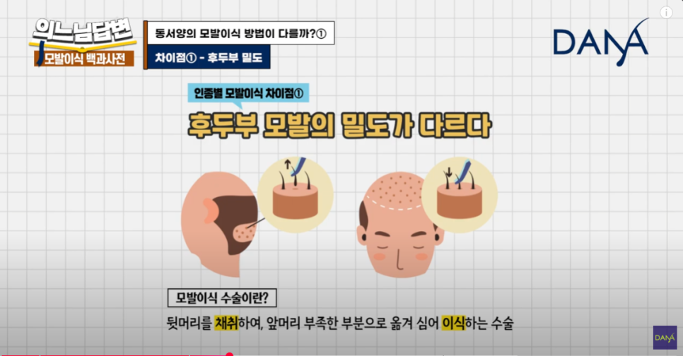 How Is Hair Transplantation Different by Race? image 3