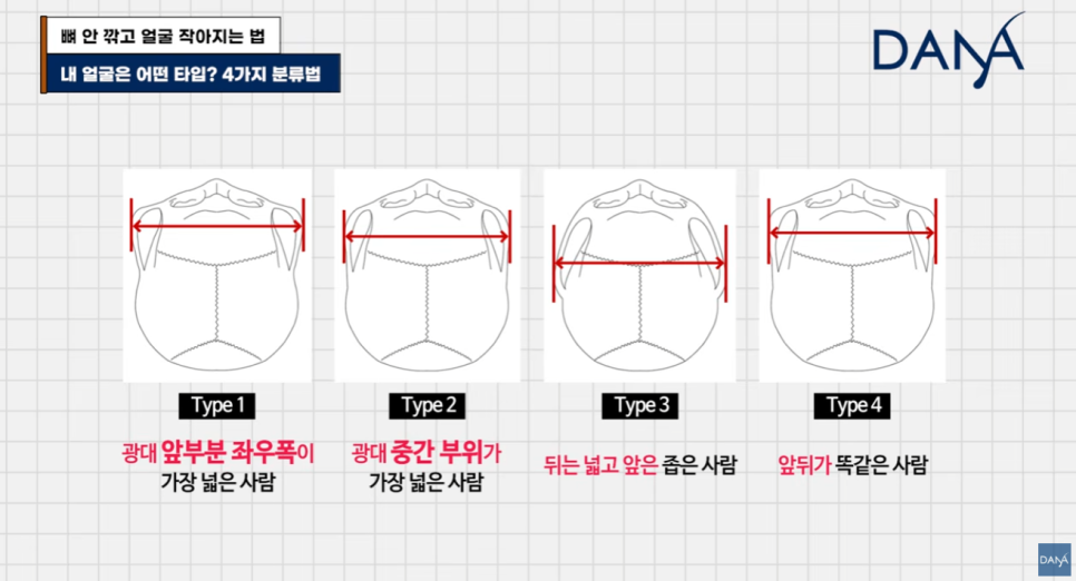 뼈 안 깎고 얼굴 작아지는 법? 광대 수술 효과 없는 관련 이미지 3