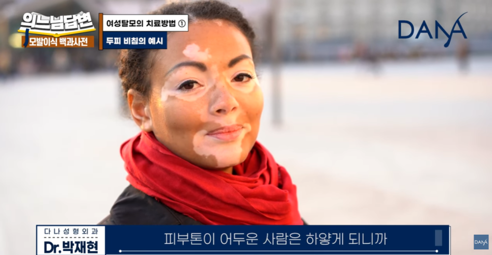 여성형 탈모, 두피문신vs모발이식? 관련 이미지 7