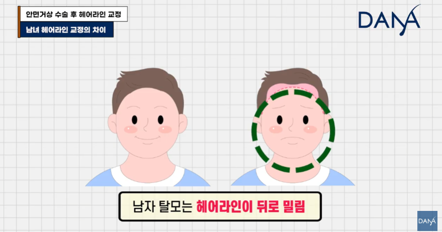 안면거상술 후 흉터와 헤어라인 변형, 자연스럽게 해결하는 방법 관련 이미지 30