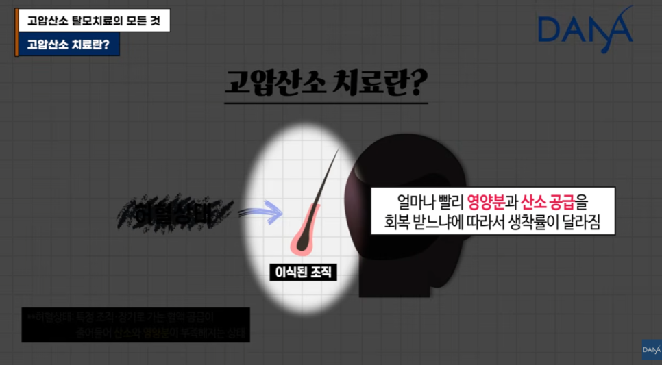 고압산소 탈모치료 돈 낭비일까? 부작용부터 효과까지 총정리 관련 이미지 2