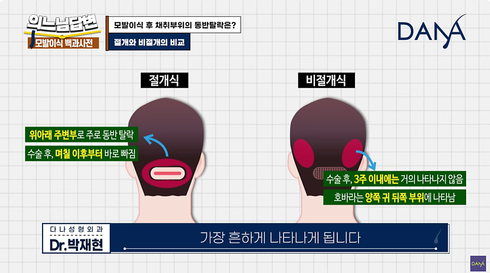 Hair Transplant Donor-Site Shedding That Can Occur After Hair Transplant Surgery image 9