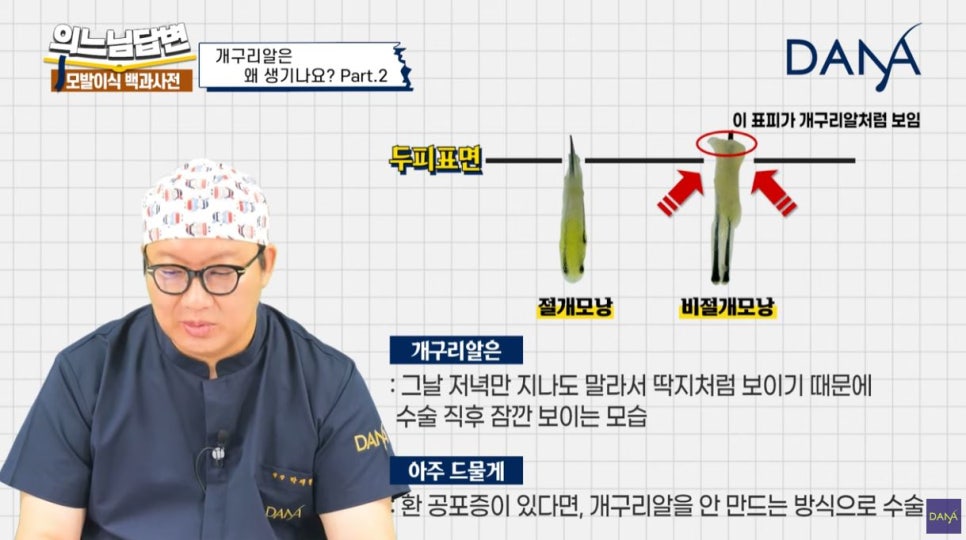 모발이식 개구리알 생기는 이유_2편 관련 이미지 1