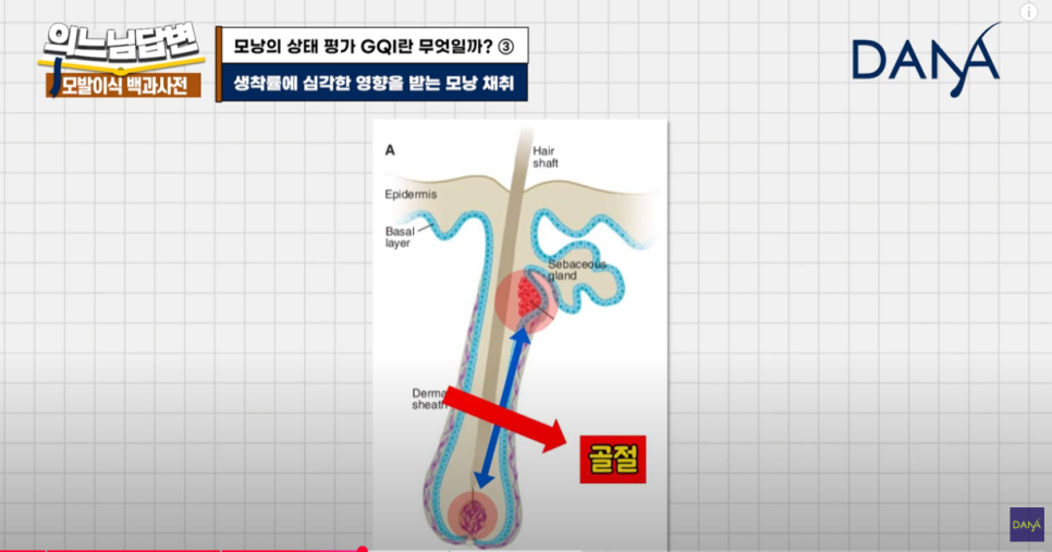 Evaluation Criteria for Hair Follicles at Dana Plastic Surgery image 7
