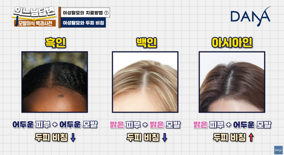 여성형 탈모, 두피문신vs모발이식? 관련 이미지 5