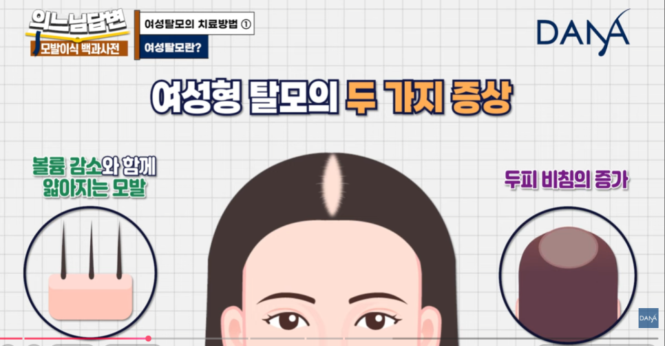 여성형 탈모, 두피문신vs모발이식? 관련 이미지 3