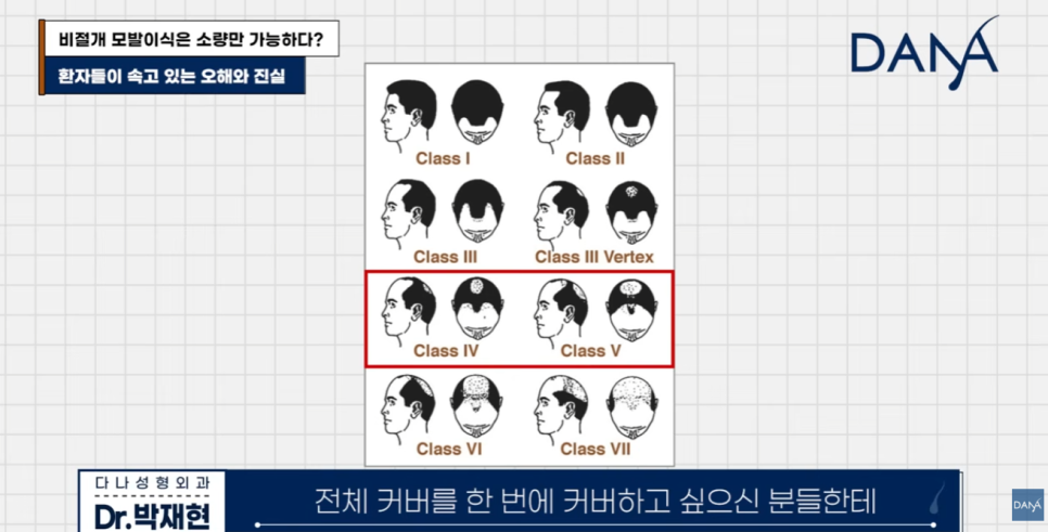 비절개 모발이식 왜 소량만 가능하다고 알려졌을까? 관련 이미지 4