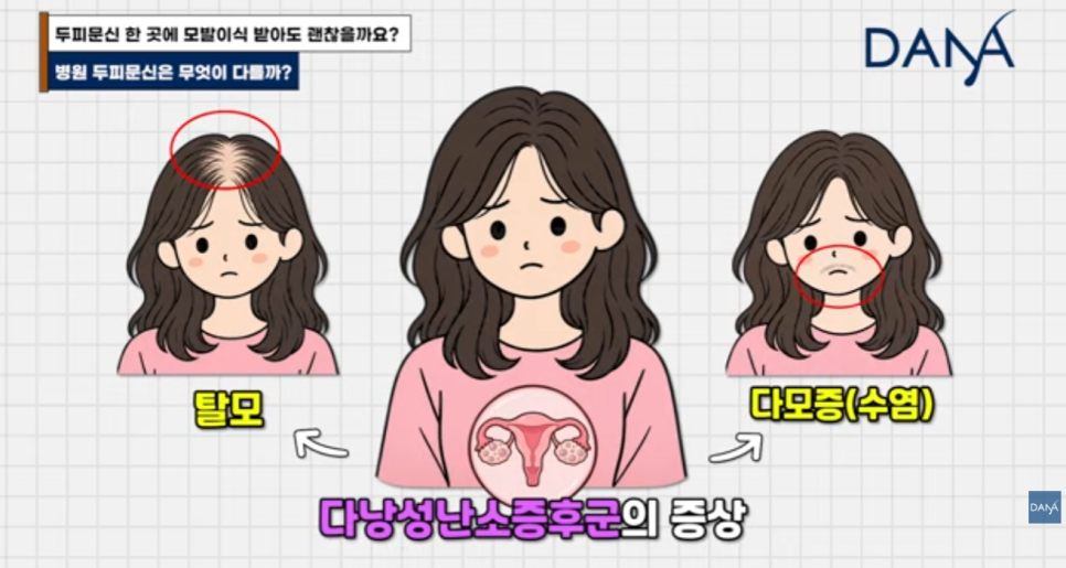 헤어라인 문신 망했는데 모발이식 가능할까? 생착률 걱정된다면 필수 체크 관련 이미지 7