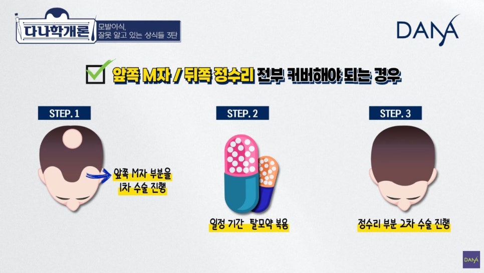 모발이식에 관해 잘못 알려진 상식들_3편 관련 이미지 4