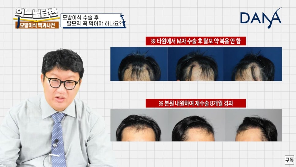 Do I Need to Keep Taking Hair Loss Medication Even After Hair Transplant Surgery? image 4