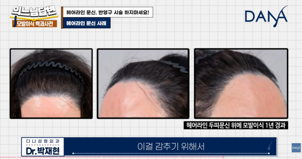 Why You Should Never Get a Hairline Scalp Tattoo image 10