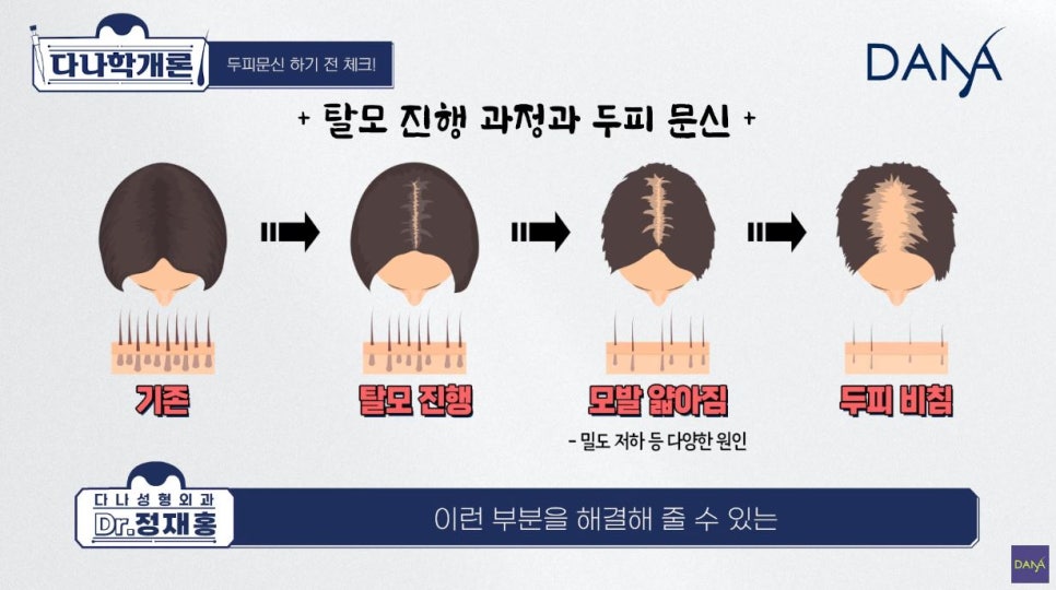 두피문신 전, 꼭 알아봐야 할 사항들 관련 이미지 5