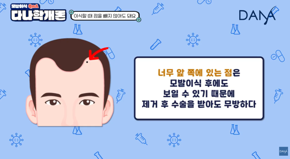 머리에 점이 있어도 모발이식 할 수 있나요? 관련 이미지 10