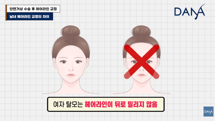 안면거상술 후 흉터와 헤어라인 변형, 자연스럽게 해결하는 방법 관련 이미지 29