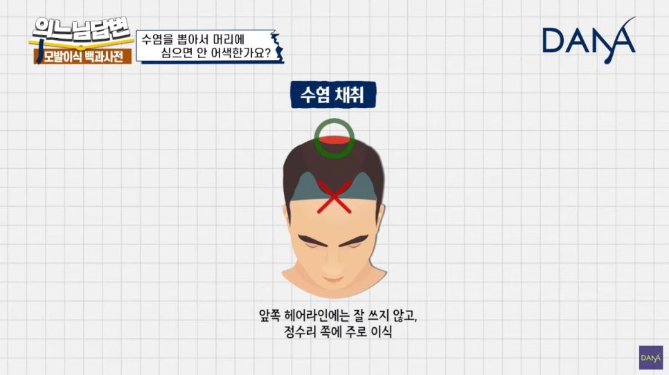 수염이식 머리카락으로 심어도 될까? 관련 이미지 3