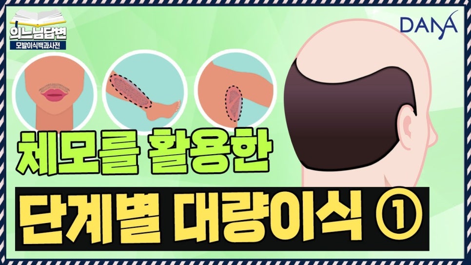 체모이식 체모를 활용한 단계별 대량이식 관련 이미지 1