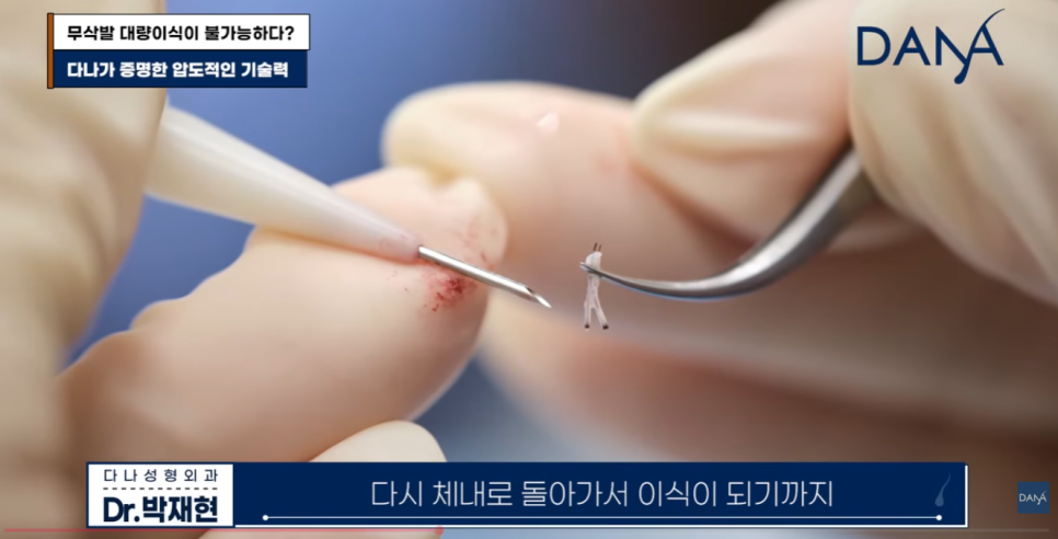 무삭발 모발이식이르 3000모 대량이식 가능할까? 생착률 높이는 진짜비밀 관련 이미지 10