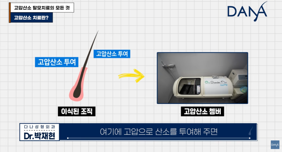 고압산소 탈모치료 돈 낭비일까? 부작용부터 효과까지 총정리 관련 이미지 5
