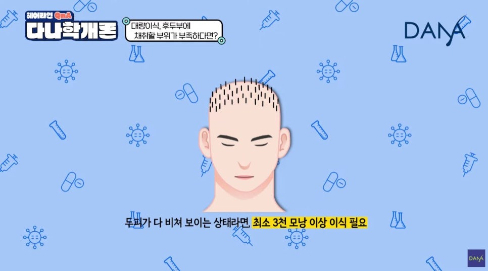 대량이식, 채취할 모발이 부족하면 어떻게 해야할까? 관련 이미지 2