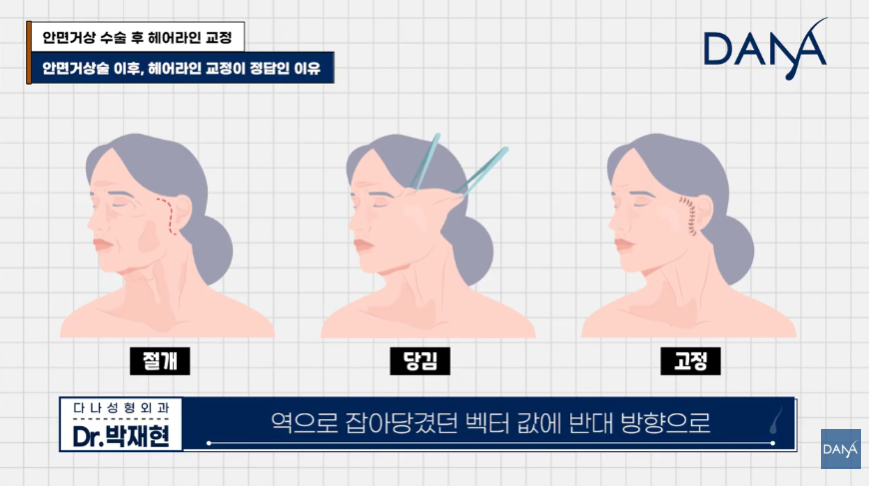안면거상술 후 흉터와 헤어라인 변형, 자연스럽게 해결하는 방법 관련 이미지 16
