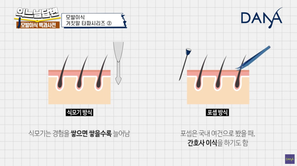 모발이식 진실 혹은 거짓 ② 관련 이미지 3