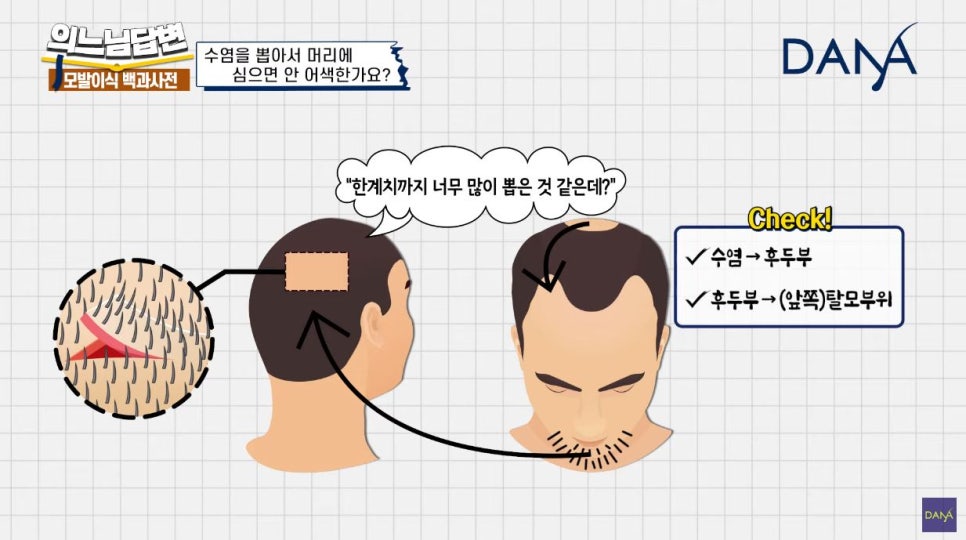 수염이식 머리카락으로 심어도 될까? 관련 이미지 5