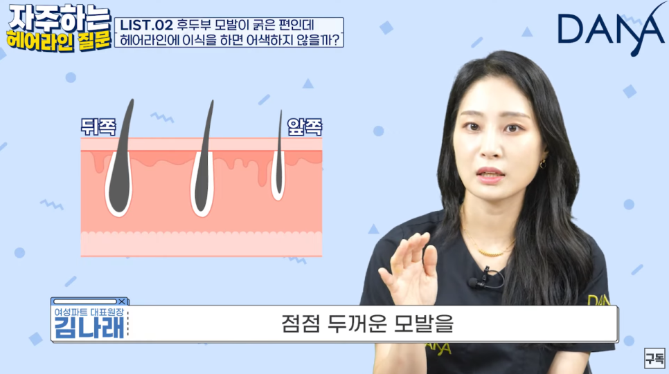 헤어라인모발이식 자연스럽게 하려면 (feat. 두꺼운모발편) 관련 이미지 6
